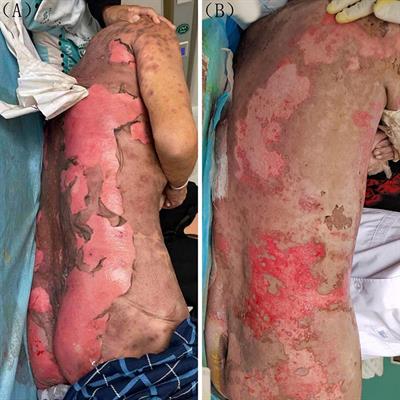 Toxic epidermal necrosis associated with afatinib: A case report and literature review